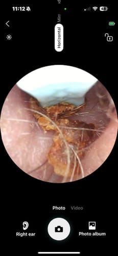 Customer photo review of ClearEar™ Earwax Removal Kit