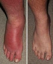 Customer photo review of LOVILDS™  Turmeric & Emu Oil Arthritis Soothing Pain Relief Massage Gel