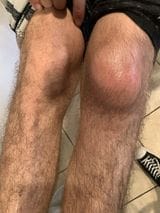 Customer photo review of BBOJ™ BoneEase Hip & Knee Therapy Cream(🔥2025 New Product Discount Set🔥)