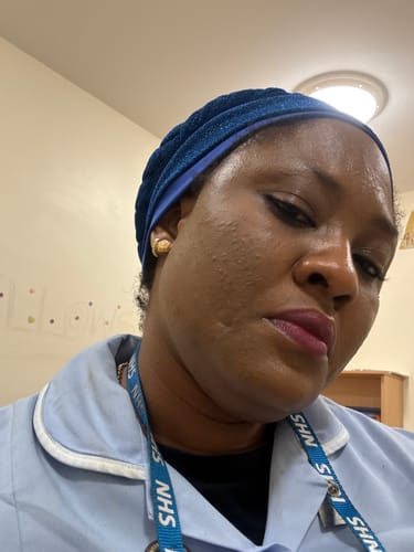 Customer photo review of Anti-Acne & Dark Spots African Soap