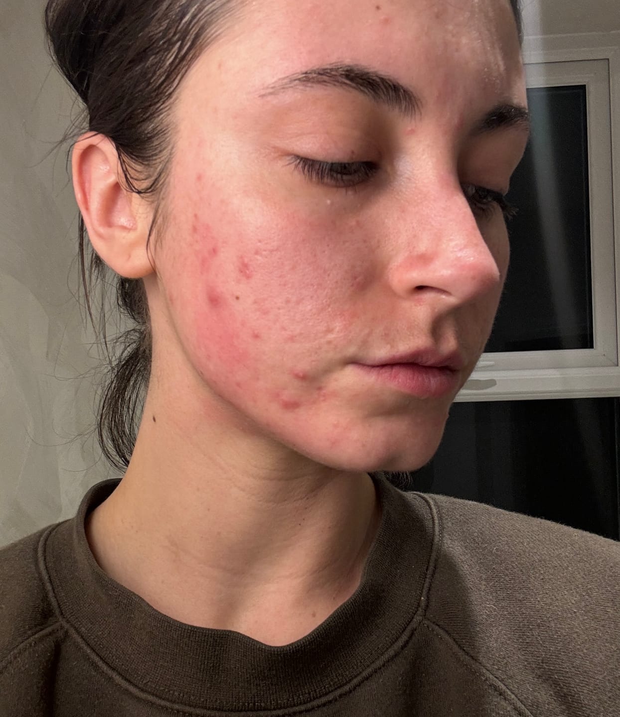 Customer photo review of Kill Acne & Redness Ritual