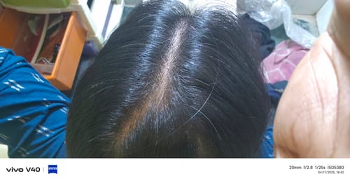 Customer photo review of INVISIBLE COVER-UP PATCH