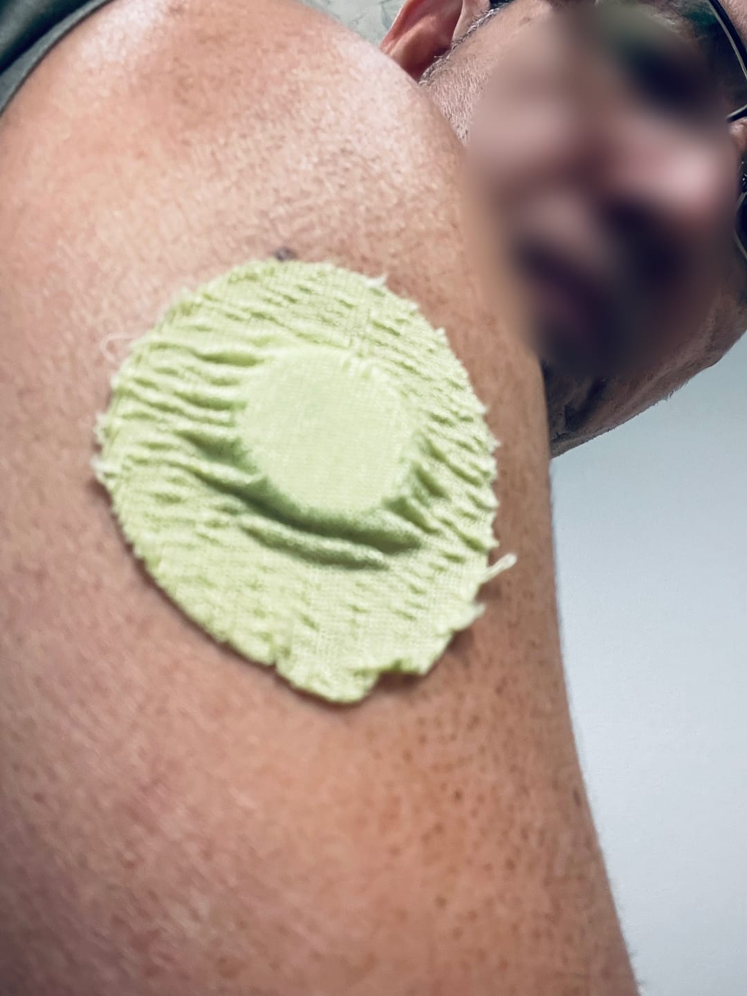 Customer photo review of Skin Grip Original - Libre 3 Adhesive Patches