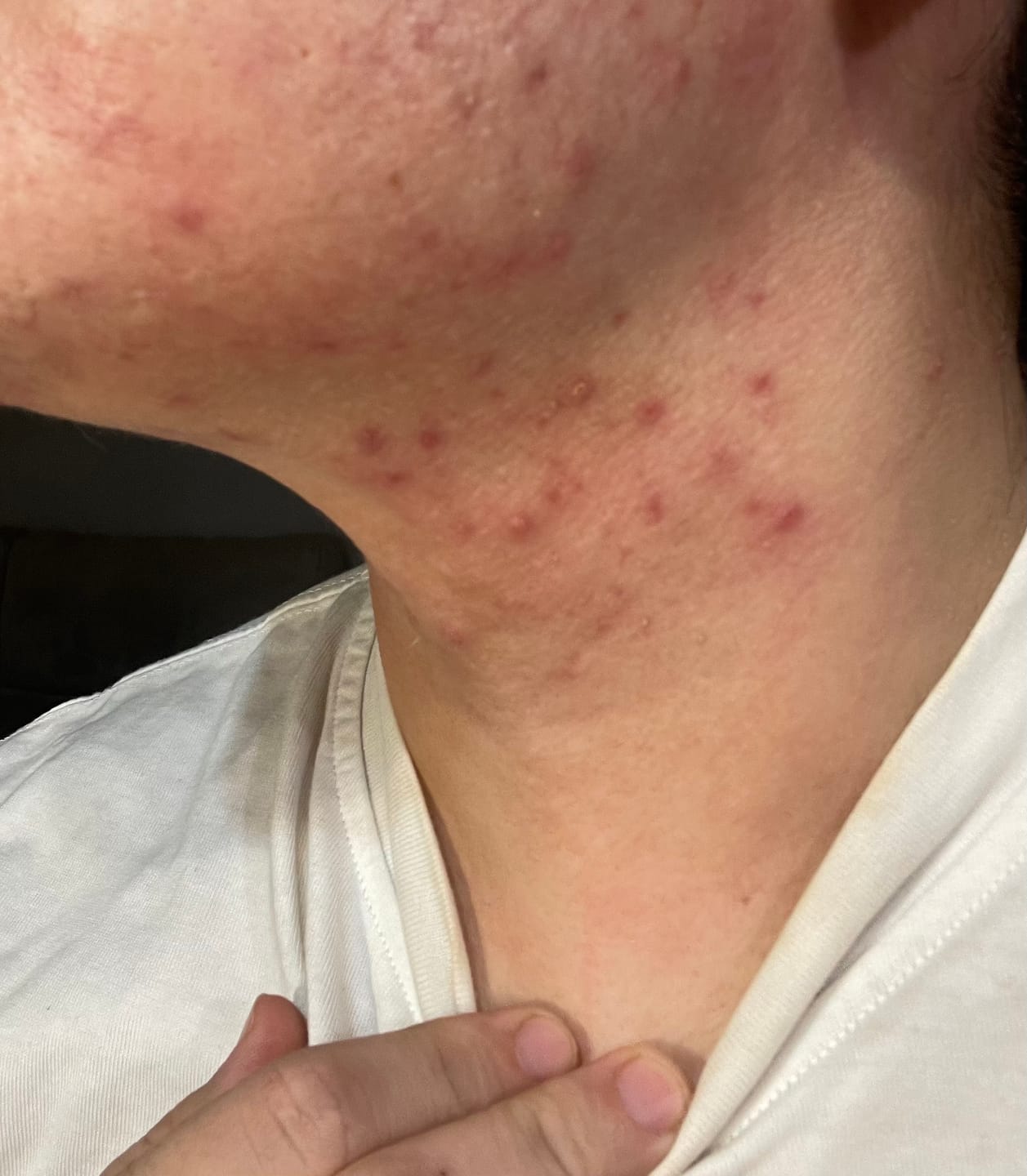 Customer photo review of A CONTROL - ACNÉ HORMONAL & RESISTENCIA A LA INSULINA