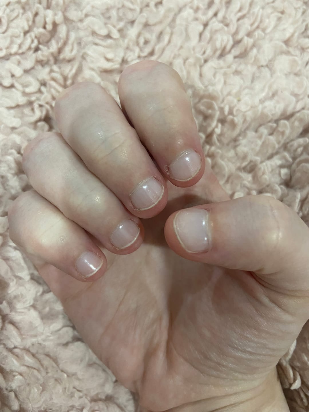 Customer photo review of Crystal Clear DIY Semicured Gel Nail Sticker Kit (STOP NAIL BITING & GROW BRITTLE NAILS)