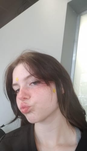 Customer photo review of Star Shaped Pimple Patch