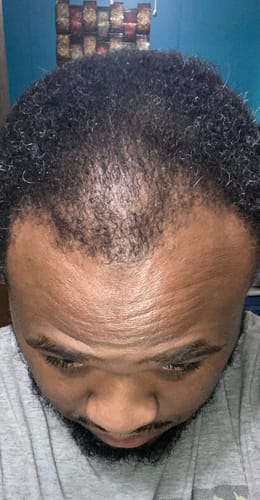 Customer photo review of VIRAL "EXTREME STRENGTH" Hair Growth Serum -