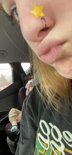 Customer photo review of Star Shaped Pimple Patch