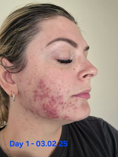 Customer photo review of Advanced Acne Program™