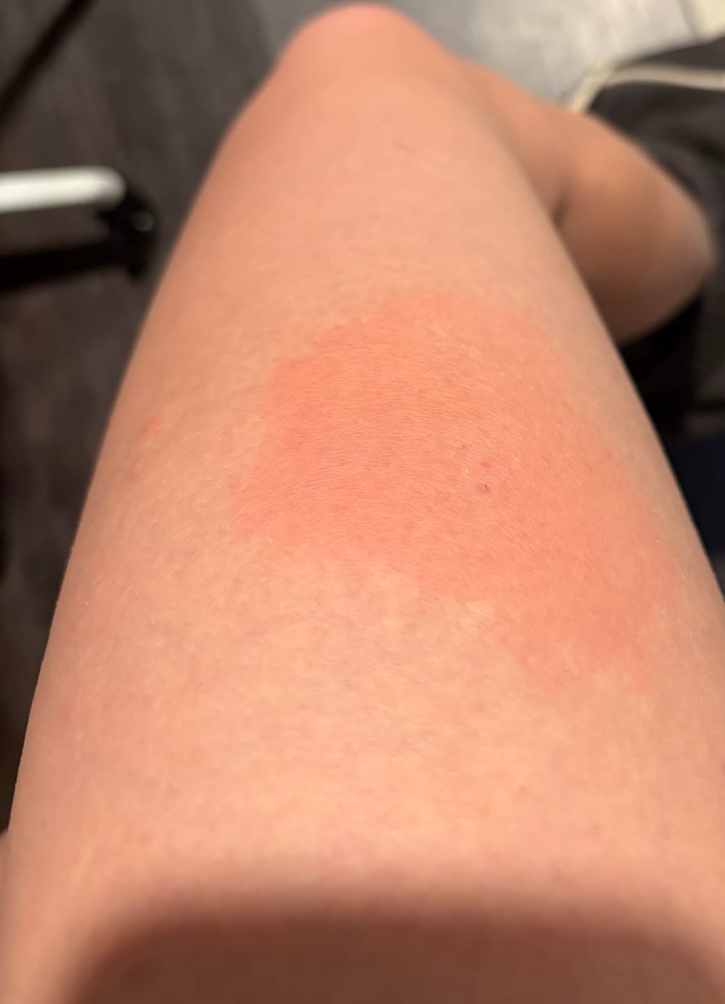 Customer photo review of Medical Grade Bee Venom Therapy Kit
