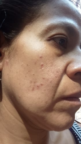 Customer photo review of Serum Personalizado (Rx)