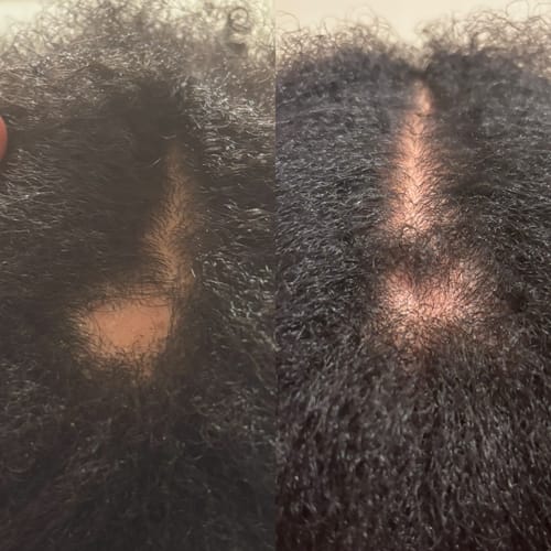 Customer photo review of Hair Regrowth Serum - Extra Strength (Large Bottle)