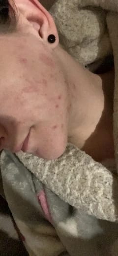 Customer photo review of PAD (COTON) ANTI-ACNÉ et ANTI -TACHES AU CURCUMA ET À L’ACIDE KOJIQUE