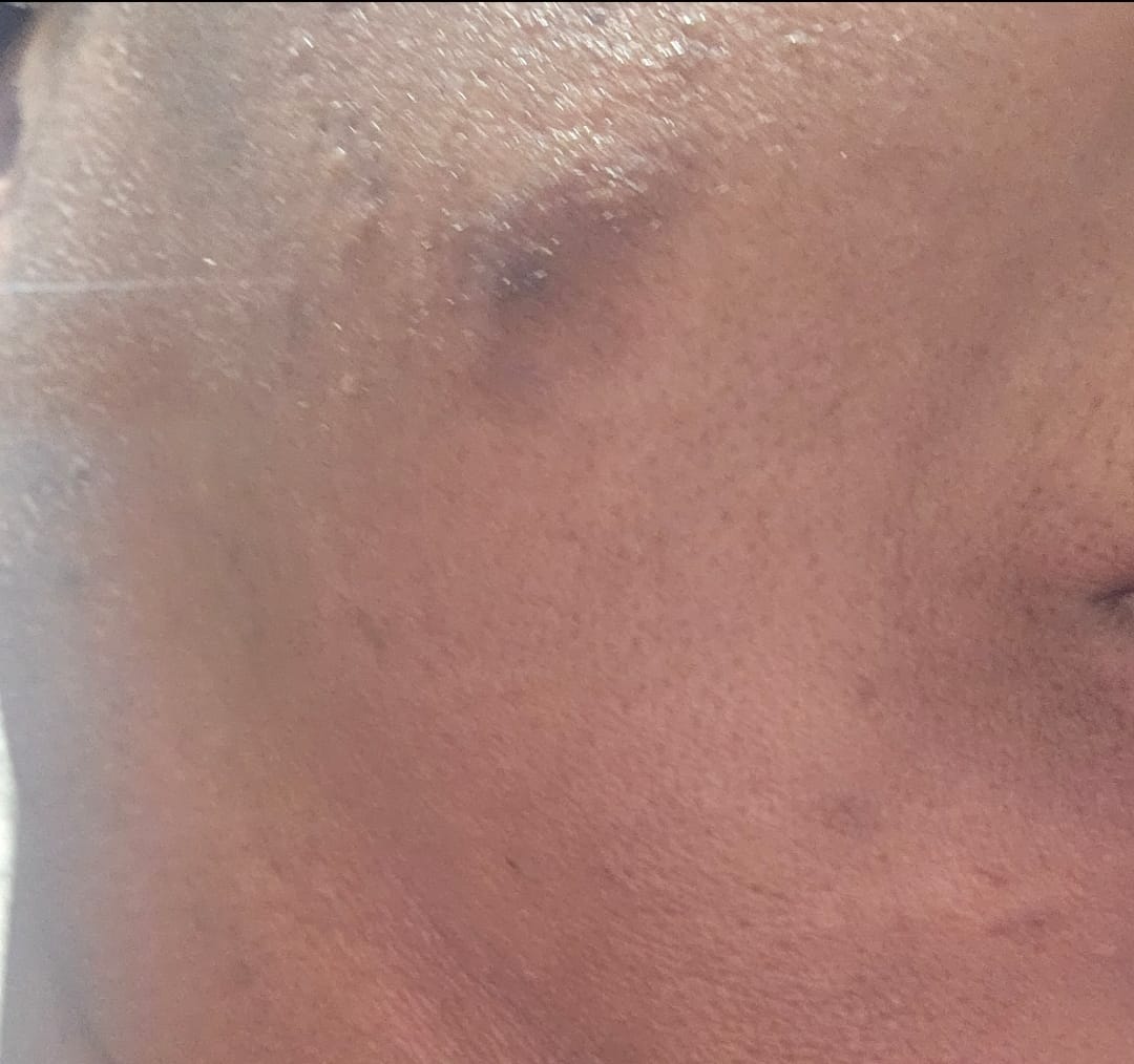 Customer photo review of Dark Spot Micro Dart Patches (with Turmeric)