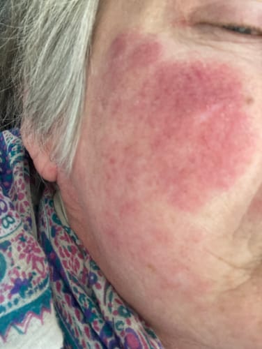 Customer photo review of Tindved- og nesle til ansikt