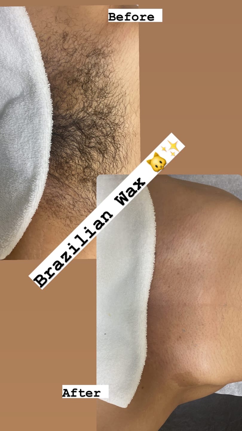 Customer photo review of Pro Series Hair Removal Wax
