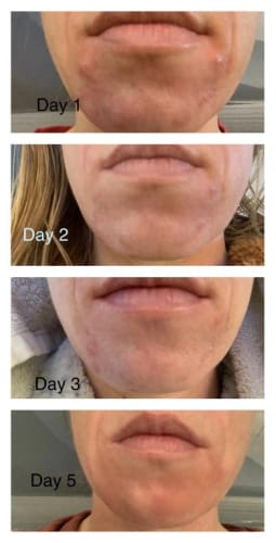 Customer photo review of PAD (COTON) ANTI-ACNÉ et ANTI -TACHES AU CURCUMA ET À L’ACIDE KOJIQUE