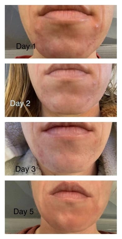 Customer photo review of PAD (COTON) ANTI-ACNÉ et ANTI -TACHES AU CURCUMA ET À L’ACIDE KOJIQUE