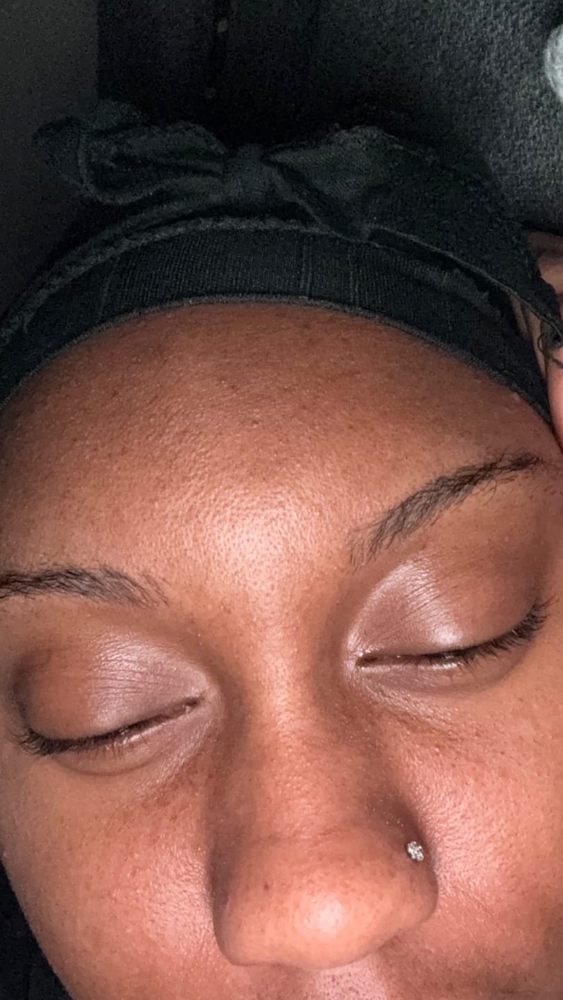 Customer photo review of LIMITED EDITION: Jolie’s Mini Full Body & Face Brightening Kit/ Acne Kit