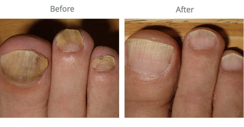 Customer photo review of Nail Fungus Laser Removal