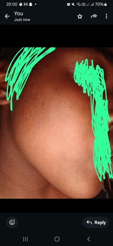 Customer photo review of Anti-Acne & Dark Spots African Soap