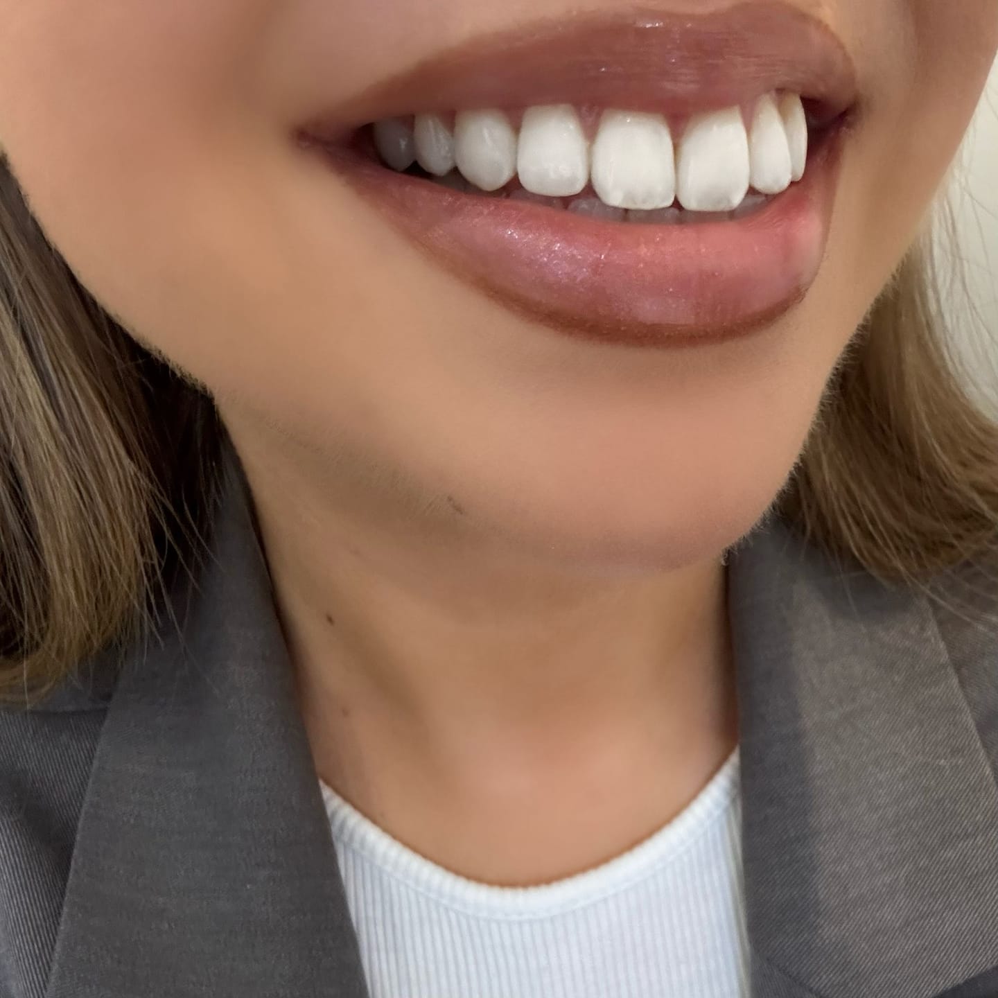 Customer photo review of Teeth Whitening Kit
