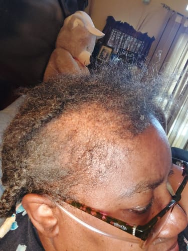 Customer photo review of Hair ReGrowth Serum 3-Pack