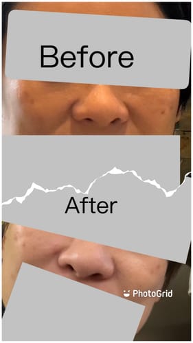 Customer photo review of Ulike超光炮美容儀-限時團購