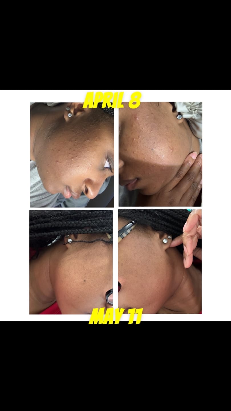 Customer photo review of LIMITED EDITION: Jolie’s Mini Full Body & Face Brightening Kit/ Acne Kit