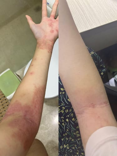 Customer photo review of Eczema Scratch Mitten