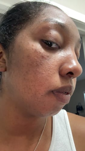 Customer photo review of 2in1 Double Cleansing Bar | Half Discoloration Brightening corrector | Half Oat Relief Acne Exfoliant