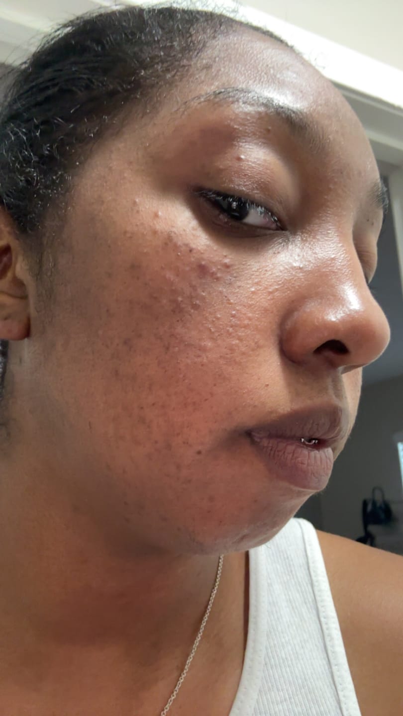Customer photo review of 2in1 Double Cleansing Bar | Half Discoloration Brightening corrector | Half Oat Relief Acne Exfoliant