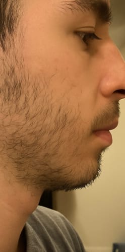 Customer photo review of Resurrection Intense Hair Growth Oil