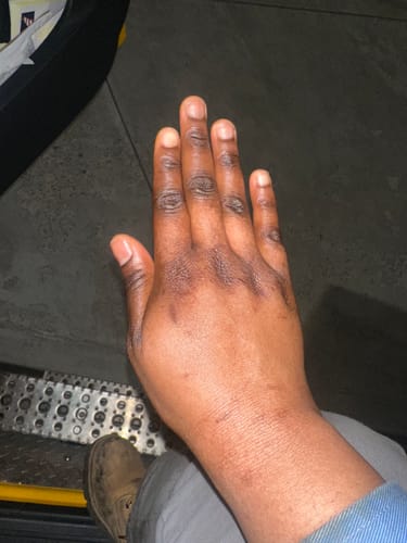 Customer photo review of Extreme Dark Hands Feet Knees And Elbows Repair Cream