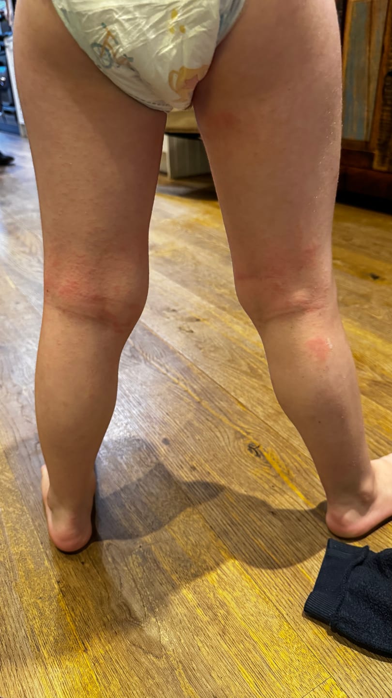 Customer photo review of Bioskin Junior Outbreak Rescue Cream