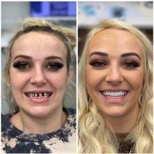 Customer photo review of Official Store | DIYSTAR™ Moldable Dentures🧑🏽‍⚕️Obtain American Dental Association (ADA) Certification ✅