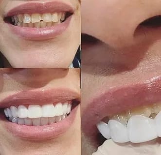 Customer photo review of Official Store | DIYSTAR™ Moldable Dentures🧑🏽‍⚕️Obtain American Dental Association (ADA) Certification ✅