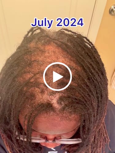 Customer video review of Four Bottles of Rennora Hair Growth Serum