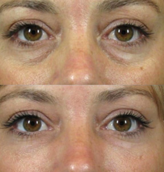 Customer photo review of Sérum Contour des Yeux – Lissant, Anti-Cernes & Anti-Relâchement