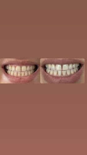 Customer photo review of Farbkorrektur - Serum