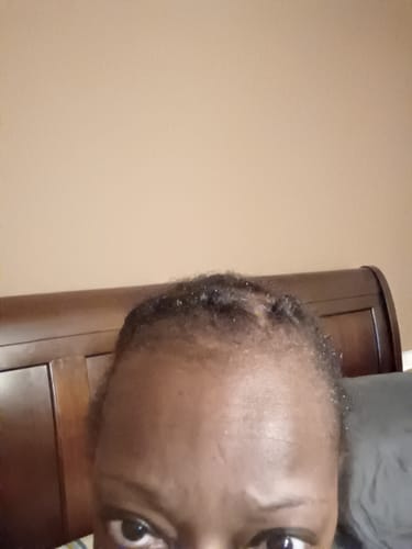 Customer photo review of Rennora Hair Growth Serum