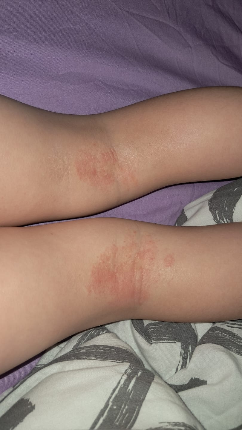 Customer photo review of Bioskin Junior Duo Pack