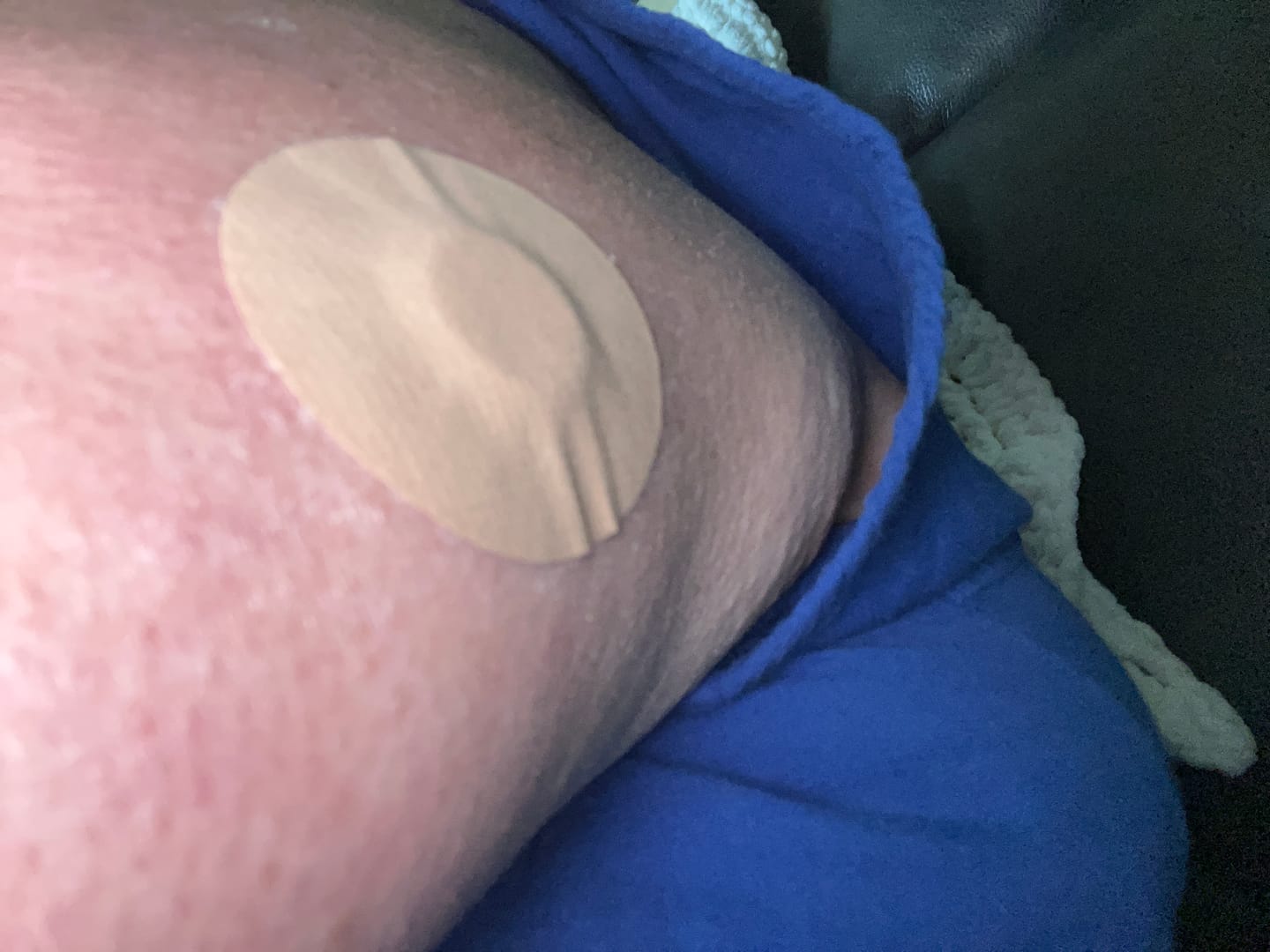 Customer photo review of Skin Grip MAX Freestyle Libre 3 Patches - 10 Pack