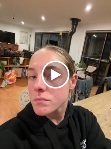 Customer video review of Pimple Pals - Pimple Patches (72)