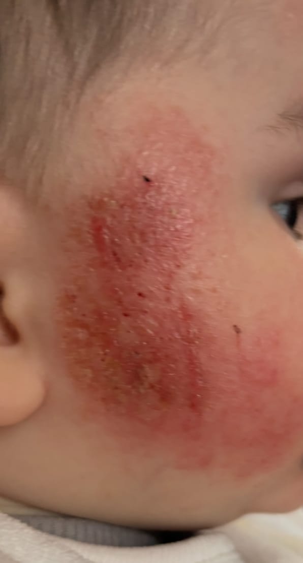 Customer photo review of Bioskin Junior Outbreak Rescue Cream