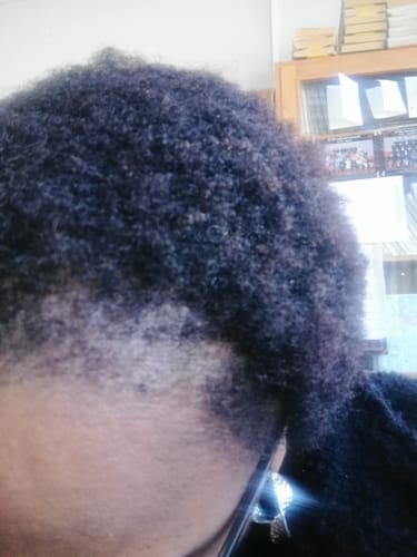 Customer photo review of NOVIFUL Hair Growth Serum - 3 PACK