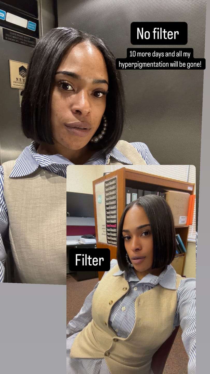 Customer photo review of BIGGER EDITION: Jolie’s Full Body & Face Brightening / Acne Kit