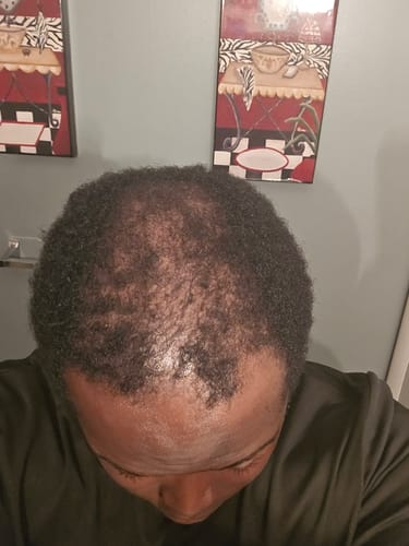 Customer photo review of Rennora EXTRA-Strength Hair Growth Serum