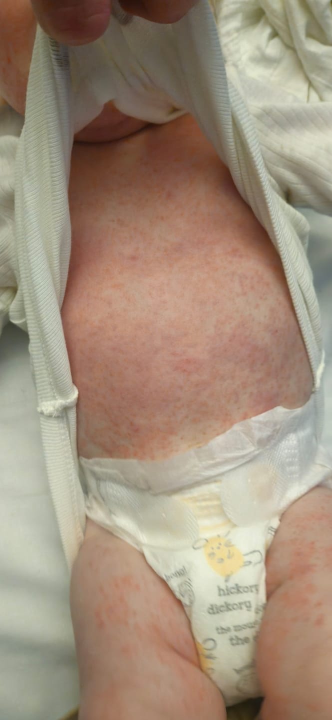 Customer photo review of Bioskin Junior Outbreak Rescue Cream