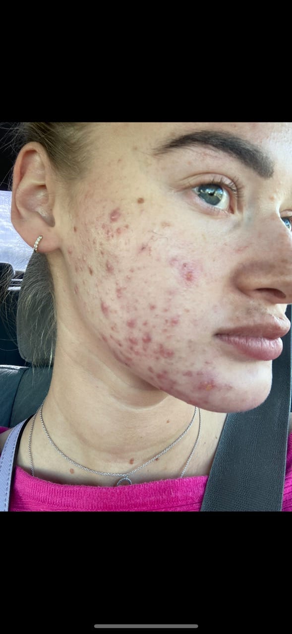 Customer photo review of Glow Up All Natural, Organic Skin Care Set to Heal Skin